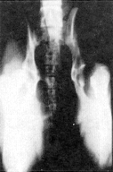 Femoral Head and Neck Excision